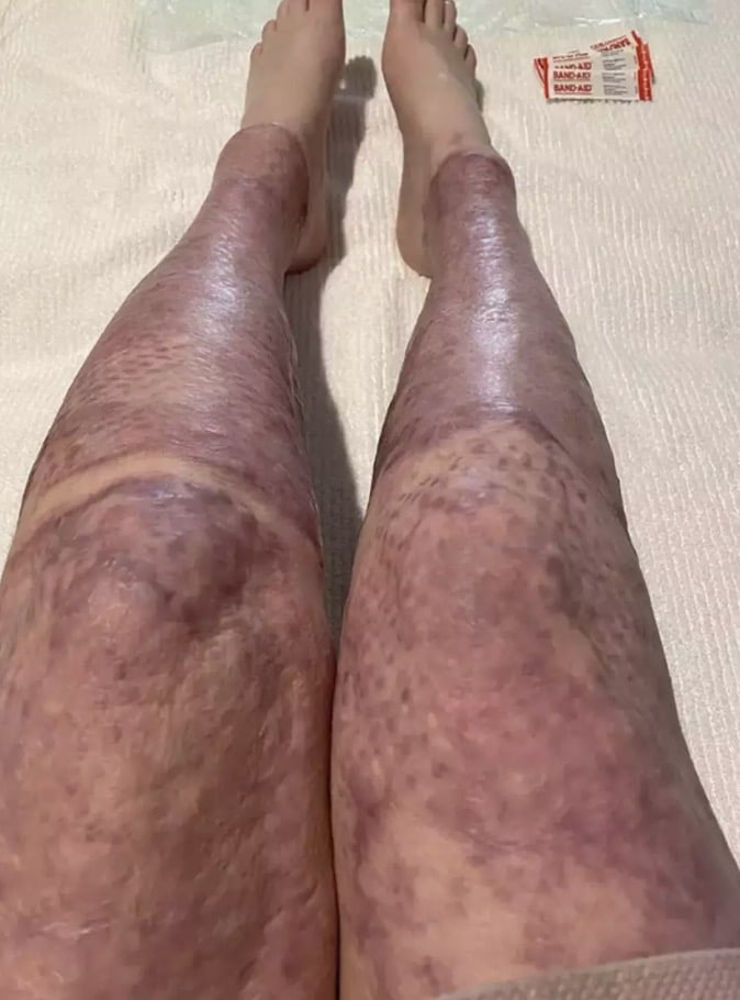 Mulher gravemente queimada em desastre vulcânico que matou 22 pessoas mostra como está 5 anos depois 70 por cento do corpo de Stephanie foi coberto por queimaduras de espessura total (Instagram/@stephaniecoral96)