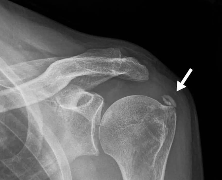 Por que algumas pessoas têm esses pequenos pontinhos brancos pelo corpo? Depósitos de cálcio no ombro
