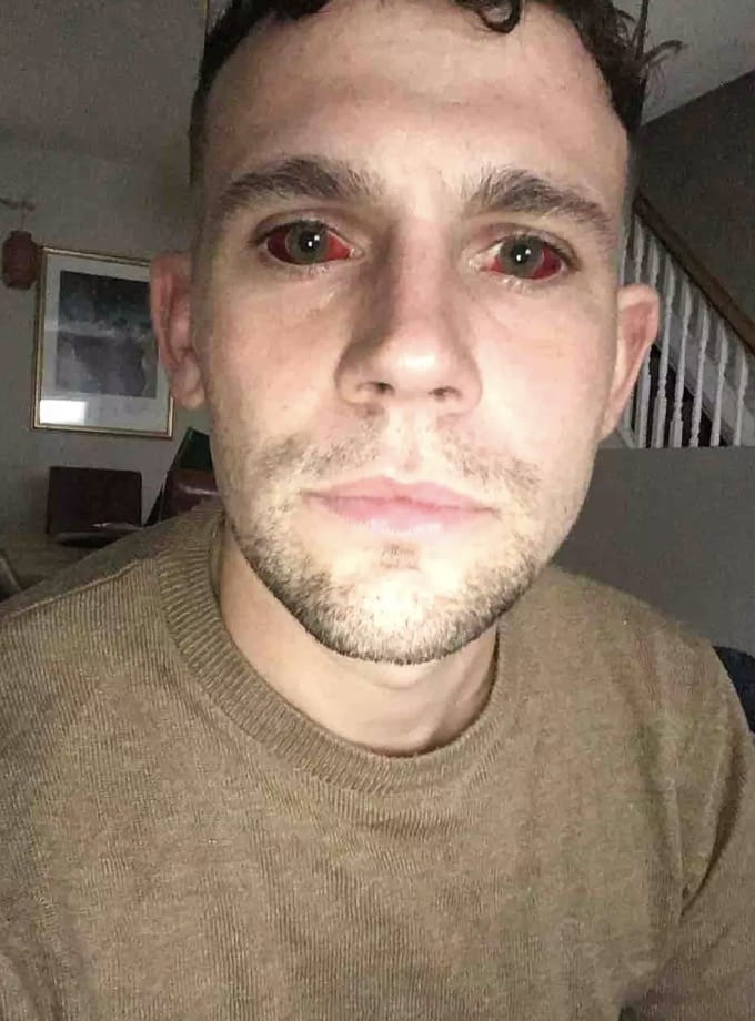 Homem faz alerta após maratona de 5 dias usando cocaína deixá-lo com "olhos de demônio" e quase levá-lo à morte Dave ficou com os olhos extremamente avermelhados (Kennedy News)