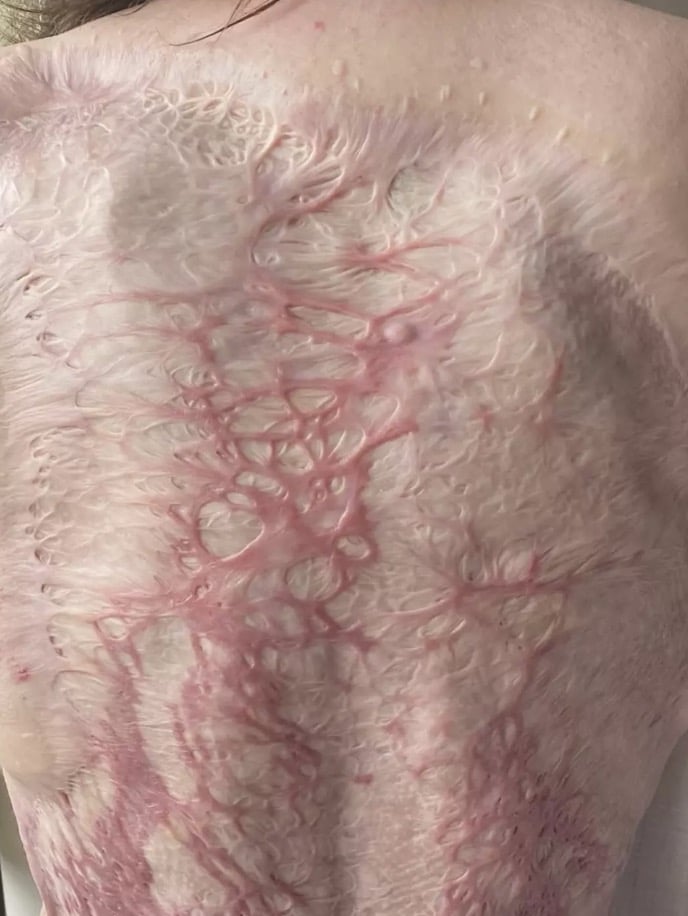 Mulher gravemente queimada em desastre vulcânico que matou 22 pessoas mostra como está 5 anos depois Ela agora vive com as cicatrizes daquele dia devastador (Instagram/@stephaniecoral96)