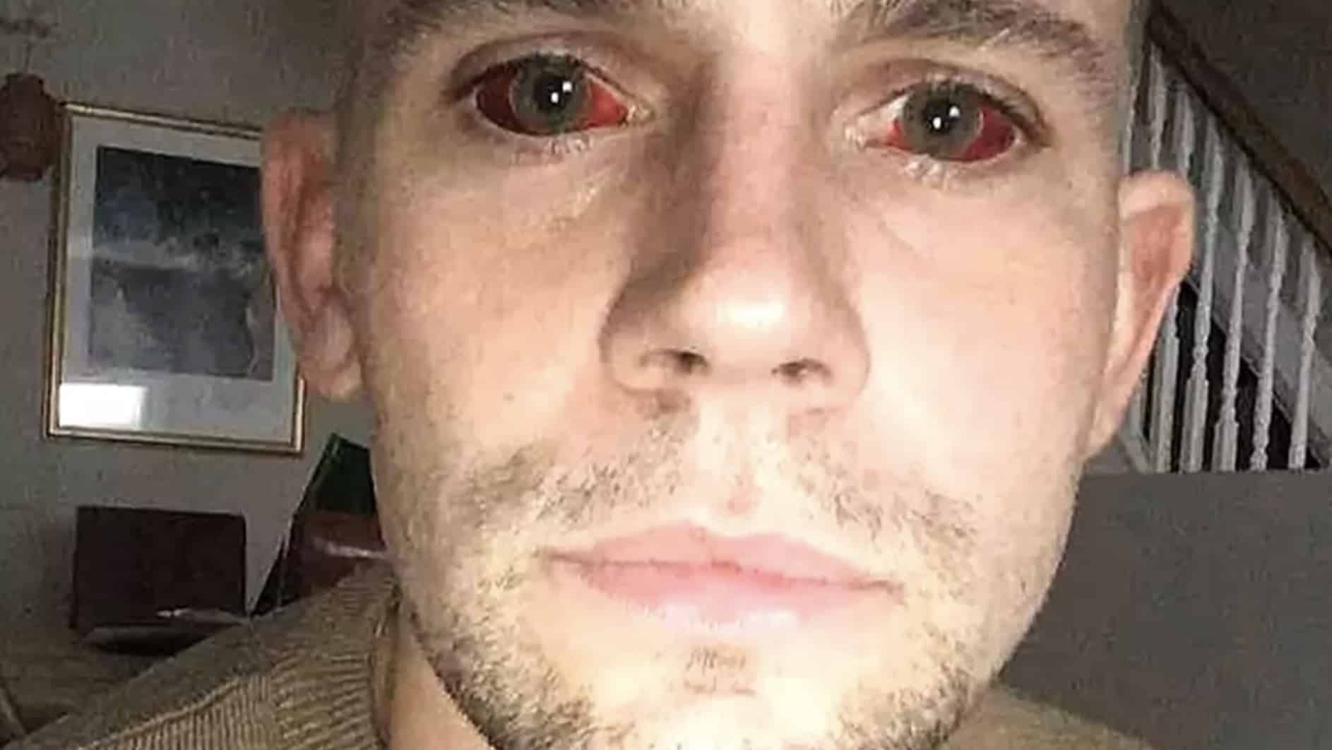 Homem faz alerta após maratona de 5 dias usando cocaína deixá-lo com "olhos de demônio" e quase levá-lo à morte Homem faz alerta após maratona de 5 dias usando cocaína deixá-lo com "olhos de demônio" e quase levá-lo à morte