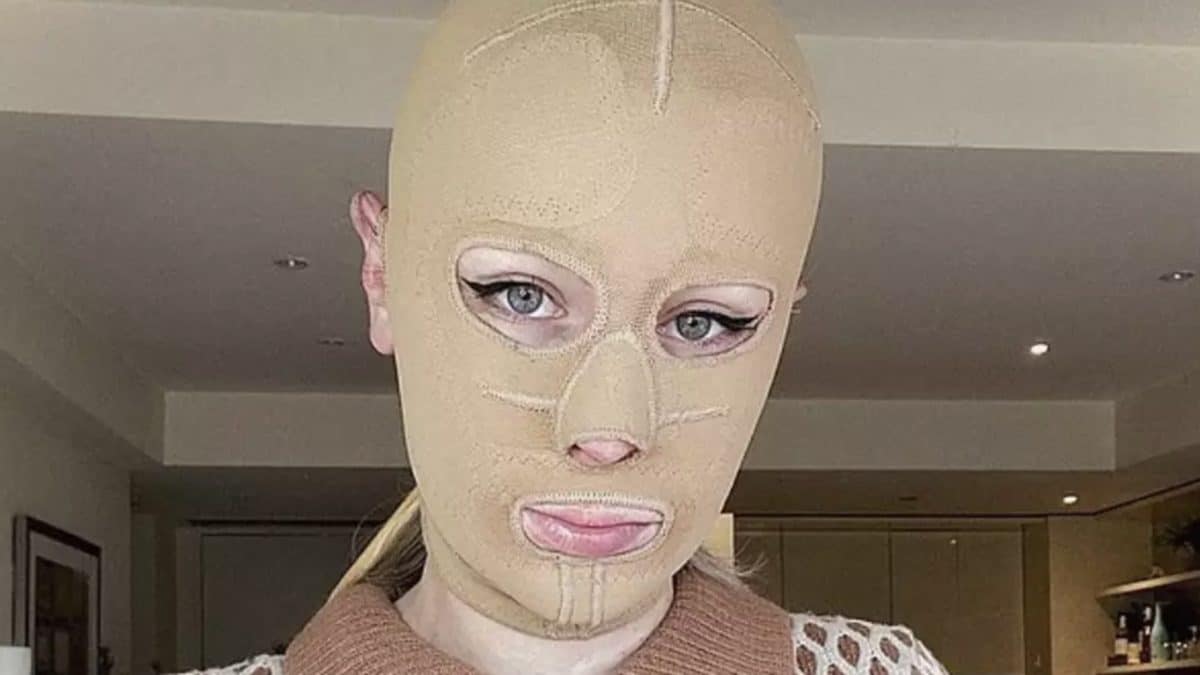 Mulher gravemente queimada em desastre vulcânico que matou 22 pessoas mostra como está 5 anos depois