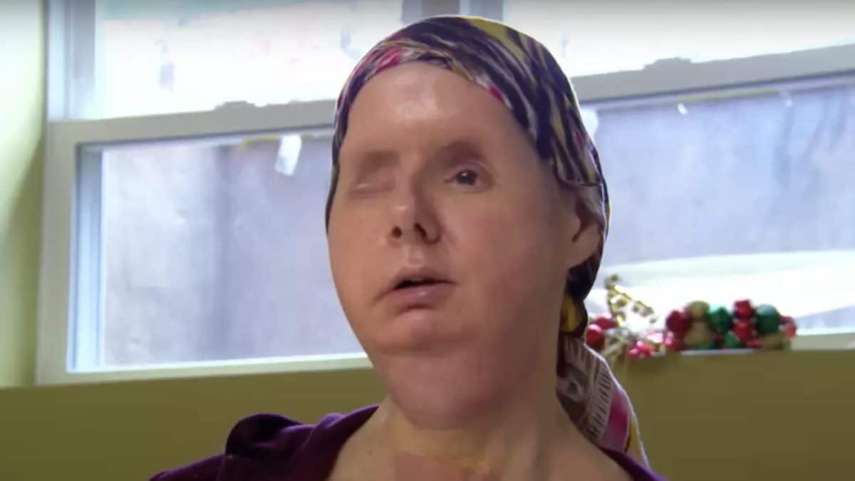 Mulher que teve o rosto arrancado por chimpanzé de estimação de amiga revela o som horrível que ouviu durante o ataque