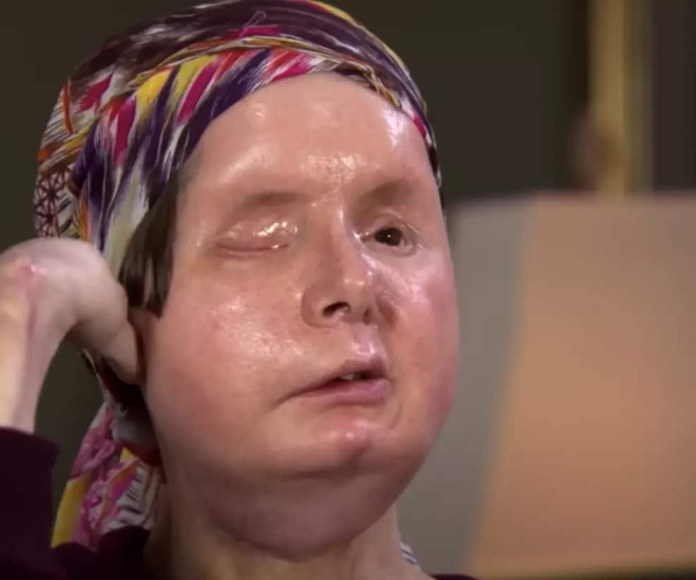 Mulher que teve o rosto arrancado por chimpanzé de estimação de amiga revela o som horrível que ouviu durante o ataque Nash passou por horas de cirurgia para reconstruir o rosto (60 Minutes Australia)