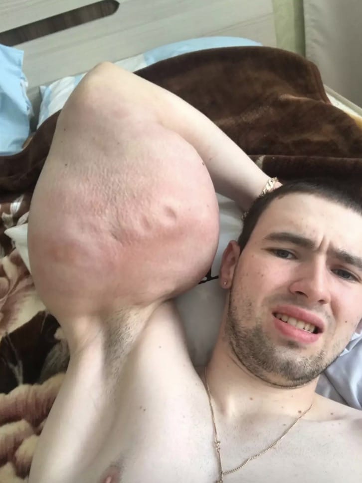 'Popeye russo' que injetou óleo nos bíceps é hospitalizado após causar graves preocupações médicas Os bíceps artificiais e inchados de Kirill Tereshin o levaram ao hospital (Instagram/@ruki_bazuki_official)
