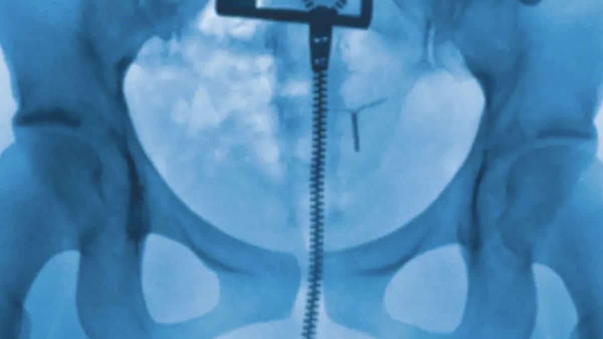 Pessoas chocadas ao descobrir detalhe perturbador que raio-X pode mostrar após enfermeira analisar a capa do álbum da Lorde
