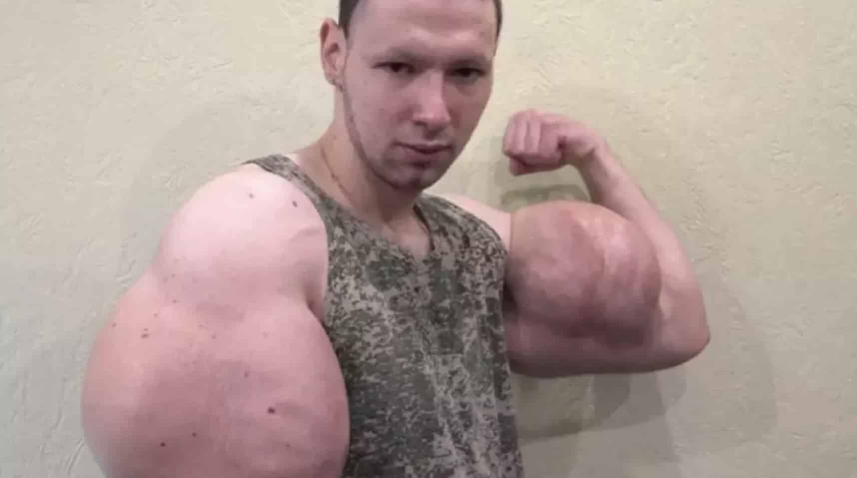 'Popeye russo' que injetou óleo nos bíceps é hospitalizado após causar graves preocupações médicas 'Popeye russo' que injetou óleo nos bíceps é hospitalizado após causar graves preocupações médicas