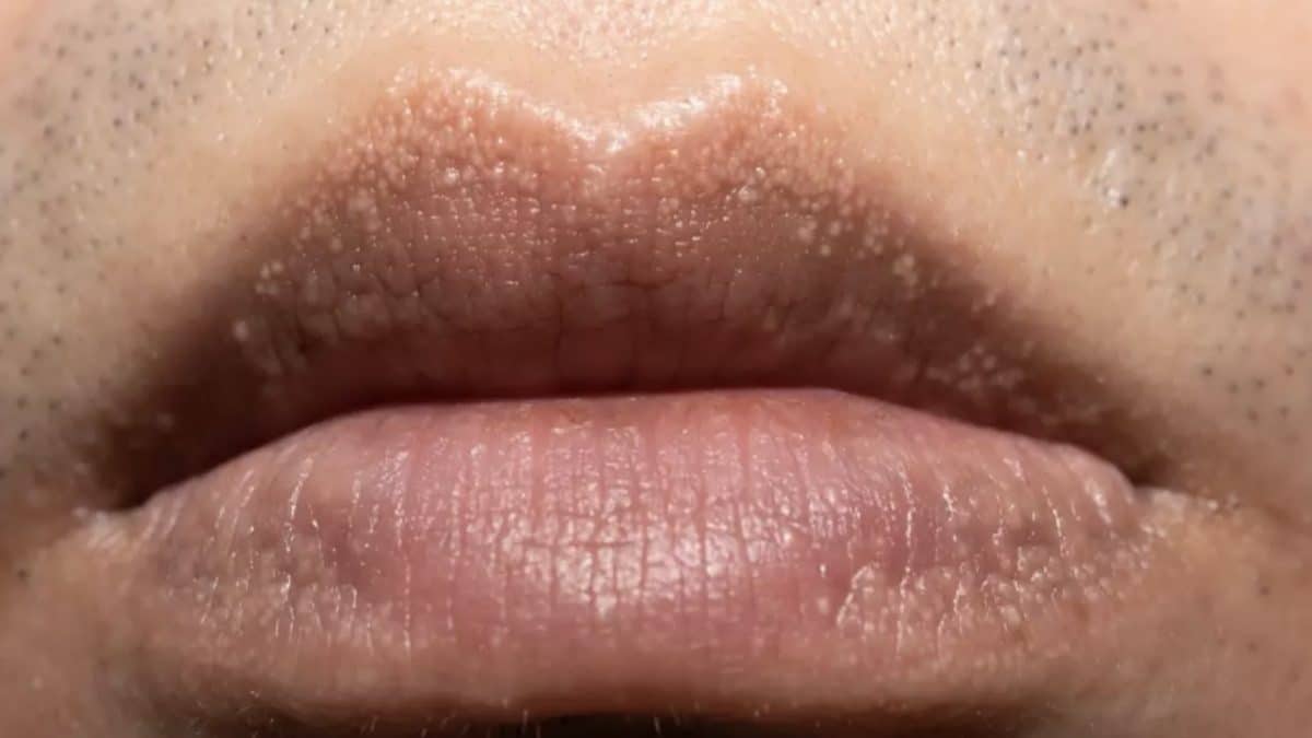 Por que algumas pessoas têm bolinhas brancas estranhas por todo o corpo, incluindo as partes íntimas?