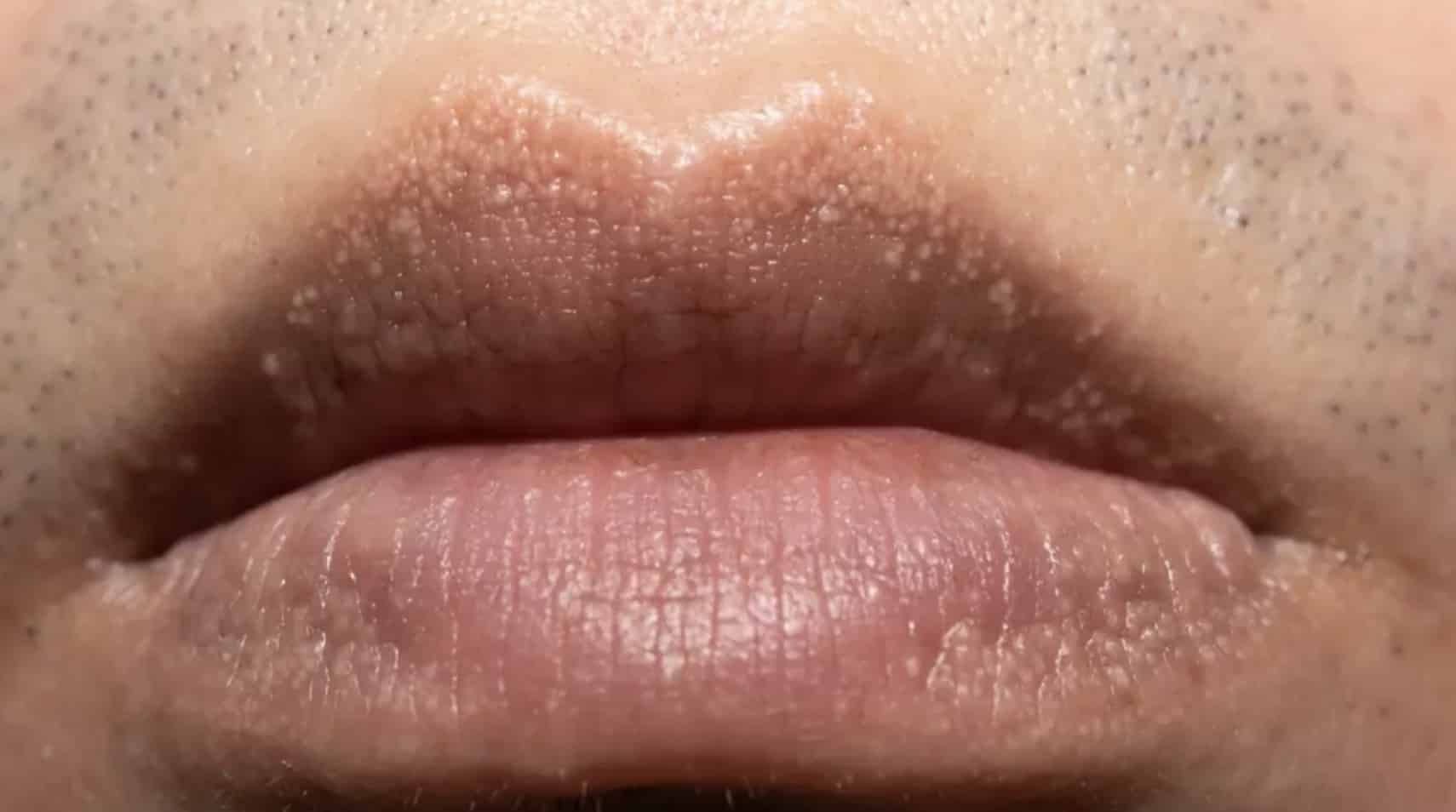 Por que algumas pessoas têm bolinhas brancas estranhas por todo o corpo, incluindo as partes íntimas? Por que algumas pessoas têm bolinhas brancas estranhas por todo o corpo, incluindo as partes íntimas?