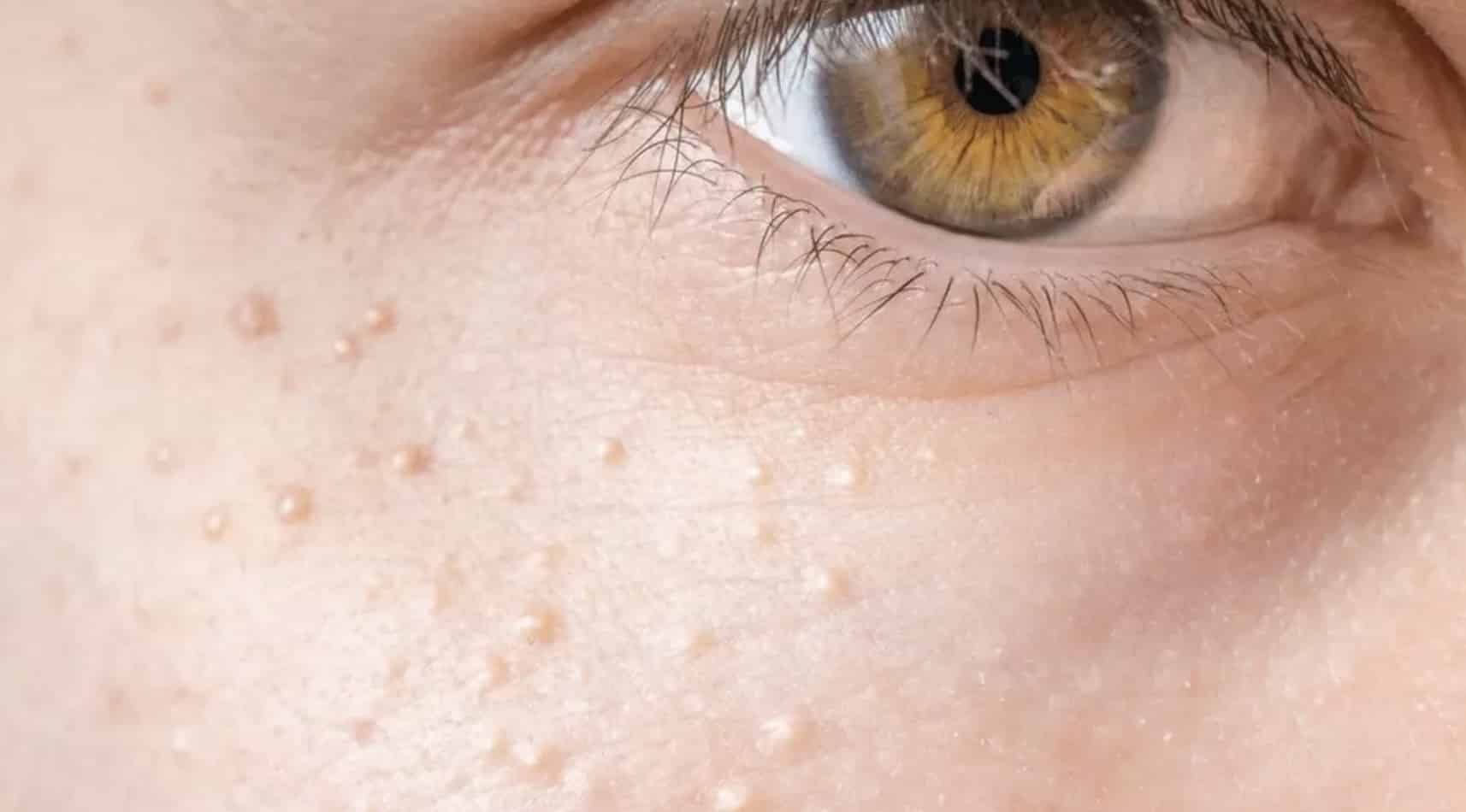 Por que algumas pessoas têm esses pequenos pontinhos brancos pelo corpo? Por que algumas pessoas têm esses pequenos pontos pelo corpo?