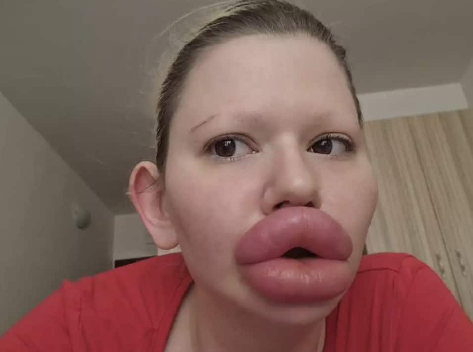 Andrea após gastar mais de US$ 26.000 com preenchimento labial (JamPress)
