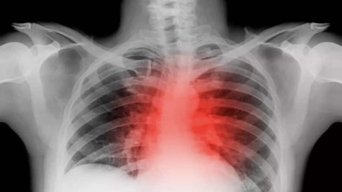 Cardiologista que sofreu um ataque cardíaco alerta as pessoas para não "cometerem o mesmo erro" diante de sinal de alerta pouco conhecido