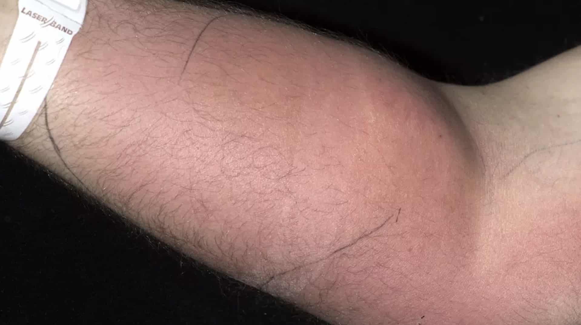 Homem sofreu efeitos colaterais horríveis após injetar seu próprio sêmen para "curar dor nas costas"