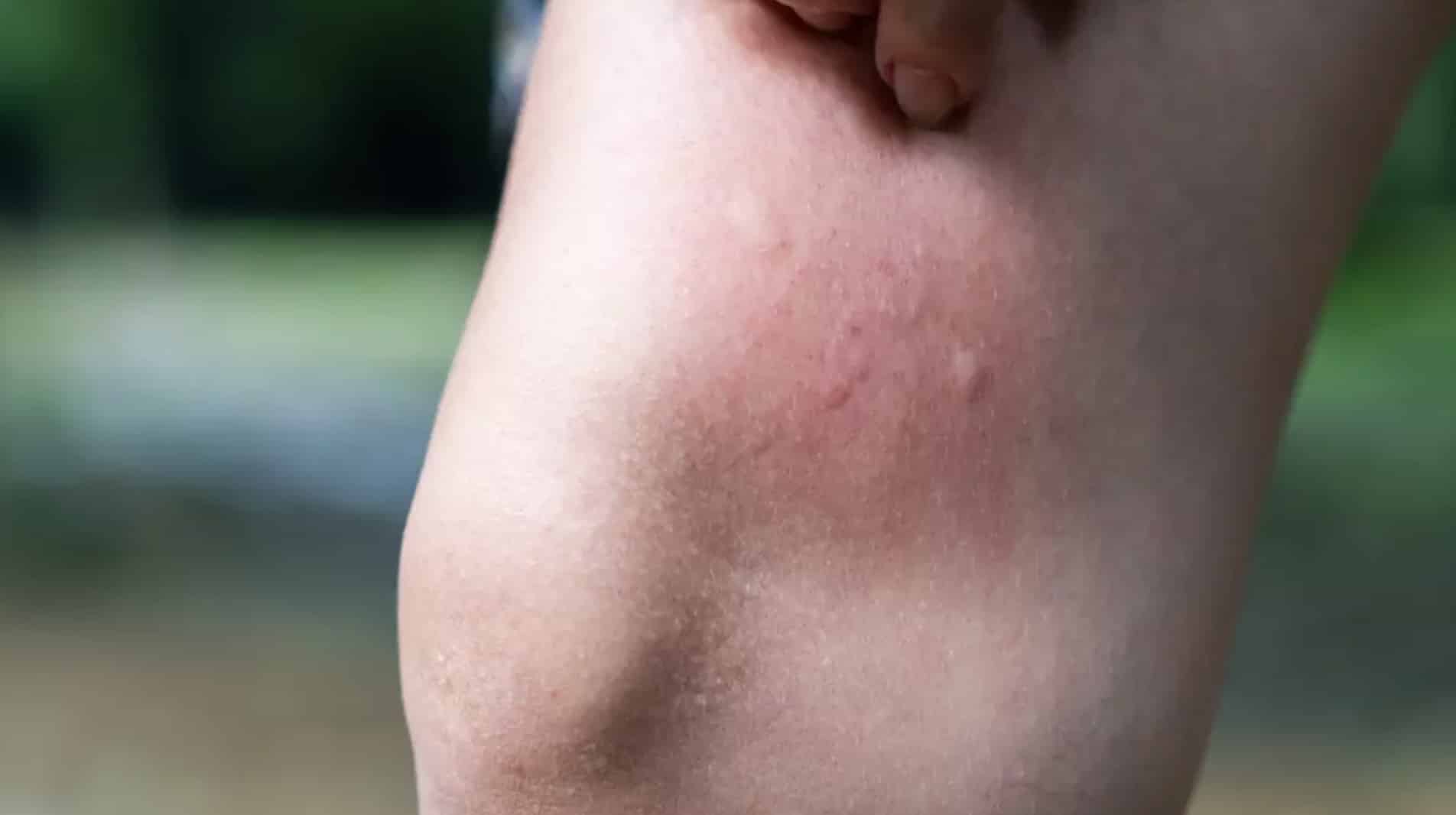 Mãe de 33 anos faz alerta após perceber que uma "picada de mosquito" era algo muito mais sinistro Mãe de 33 anos faz alerta após perceber que uma "picada de mosquito" era algo muito mais sinistro