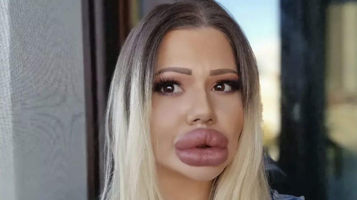Mulher com os maiores lábios do mundo mostra como era antes das cirurgias