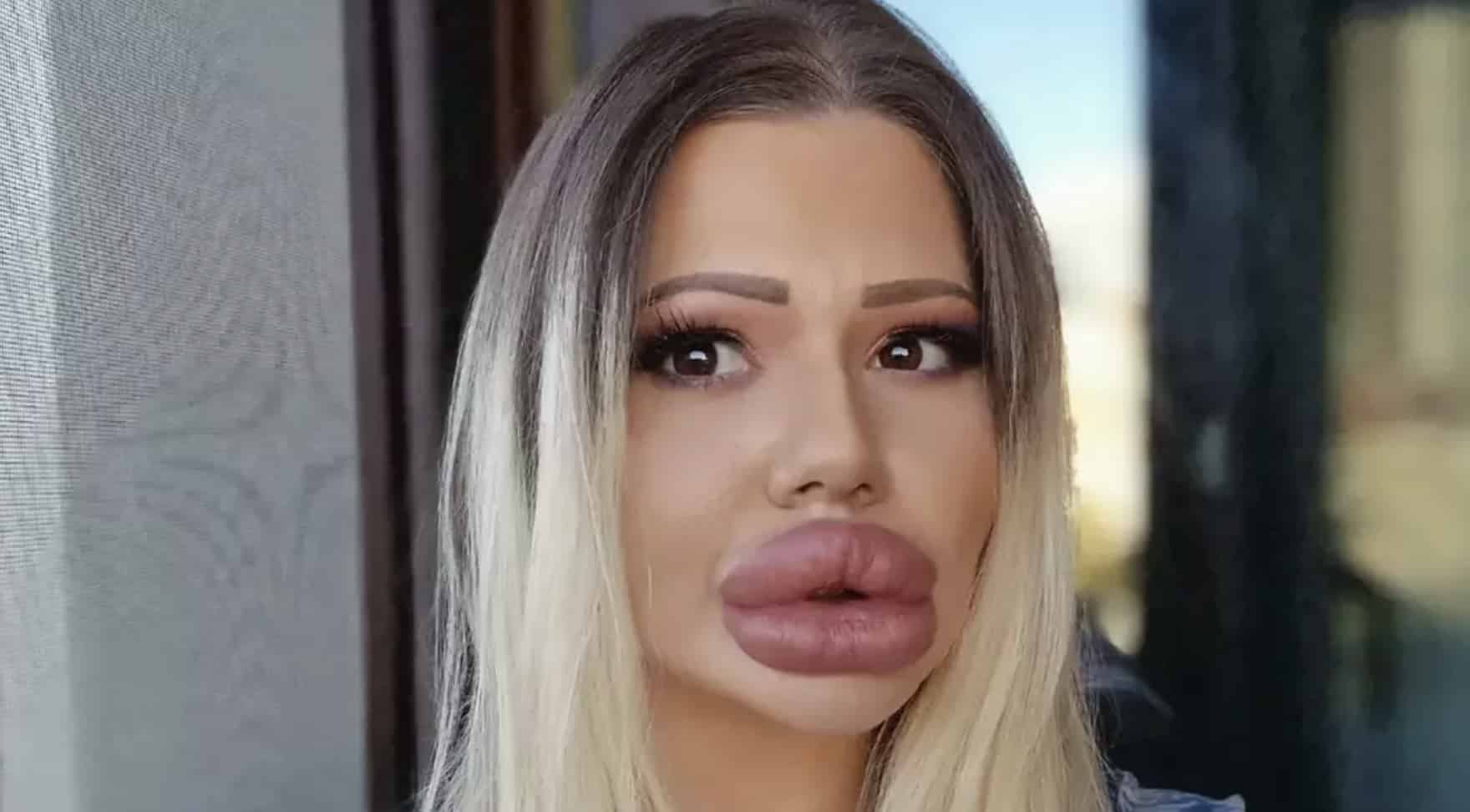 Mulher com os maiores lábios do mundo mostra como era antes das cirurgias