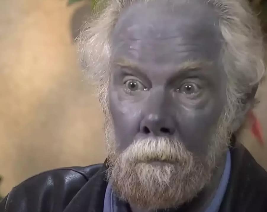 O caso bizarro do homem que sofreu efeito colateral horrível e ficou permanentemente azul O americano infelizmente faleceu em 2013 (YouTube/Inside Edition)