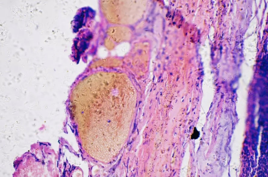Homem de 50 anos é diagnosticado com câncer fatal após notar sintoma bizarro ao tomar uma taça de vinho Simon descobriu que o nódulo era um melanoma