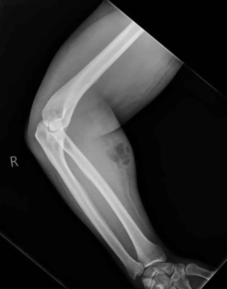 Um raio-X mostrou o acúmulo de sêmen sob a pele do homem (Irish Medical Journal)