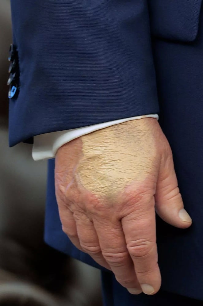 Pessoas ficam profundamente preocupadas com a saúde de Trump após nova foto revelar a "quantidade de base" em sua mão A foto mostra sua mão com base de maquiagem nela