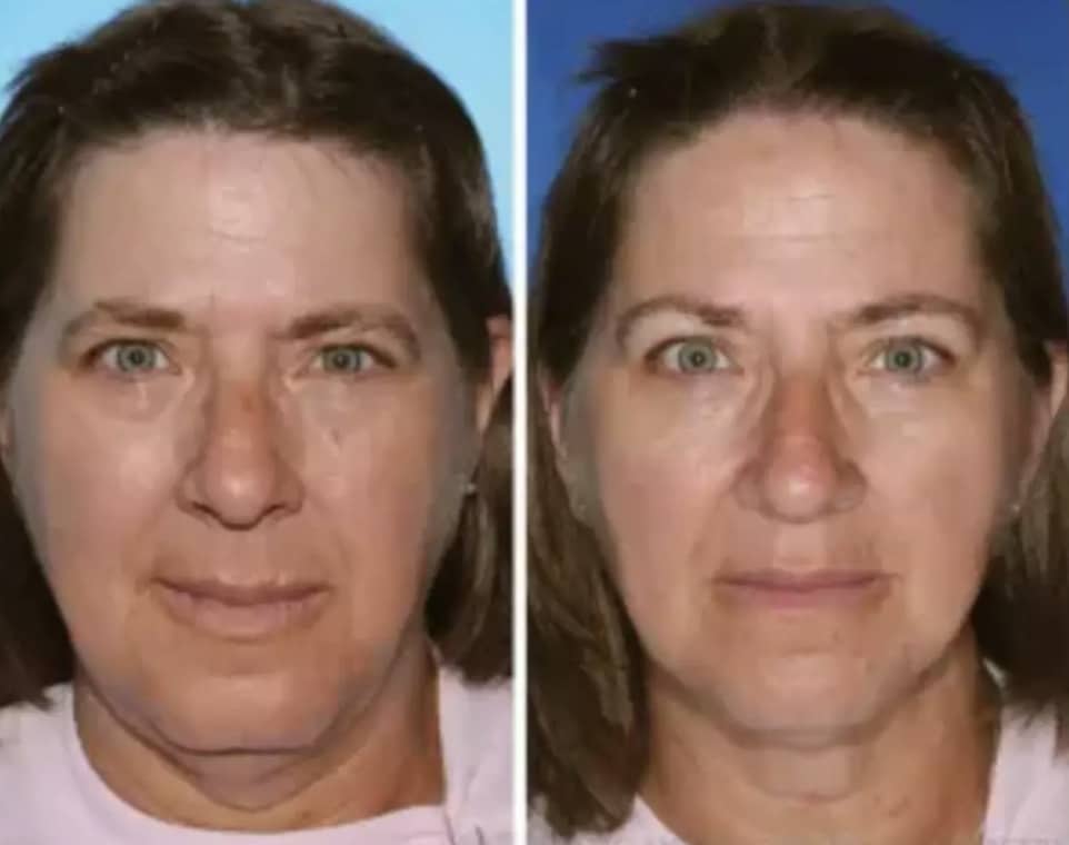 Gêmeos revelam mudança chocante no rosto após um deles fumar e o outro não A gêmea à esquerda fumou por mais de duas décadas a mais do que sua irmã (Sociedade Americana de Cirurgiões Plásticos)