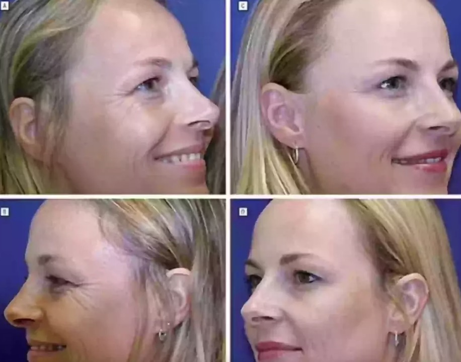 A gêmea da direita tomou injeções regulares de Botox (American Medical Association)