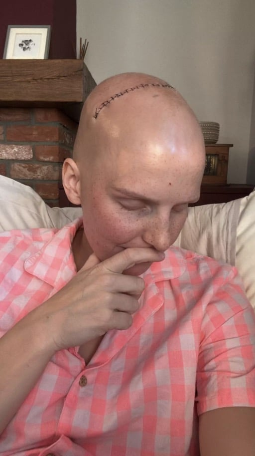 Mulher diagnosticada com câncer avançado faz alerta sério após médico recusar exame por ela ser "jovem demais" Alice está se recuperando de uma cirurgia cerebral de emergência (Kennedy News and Media)