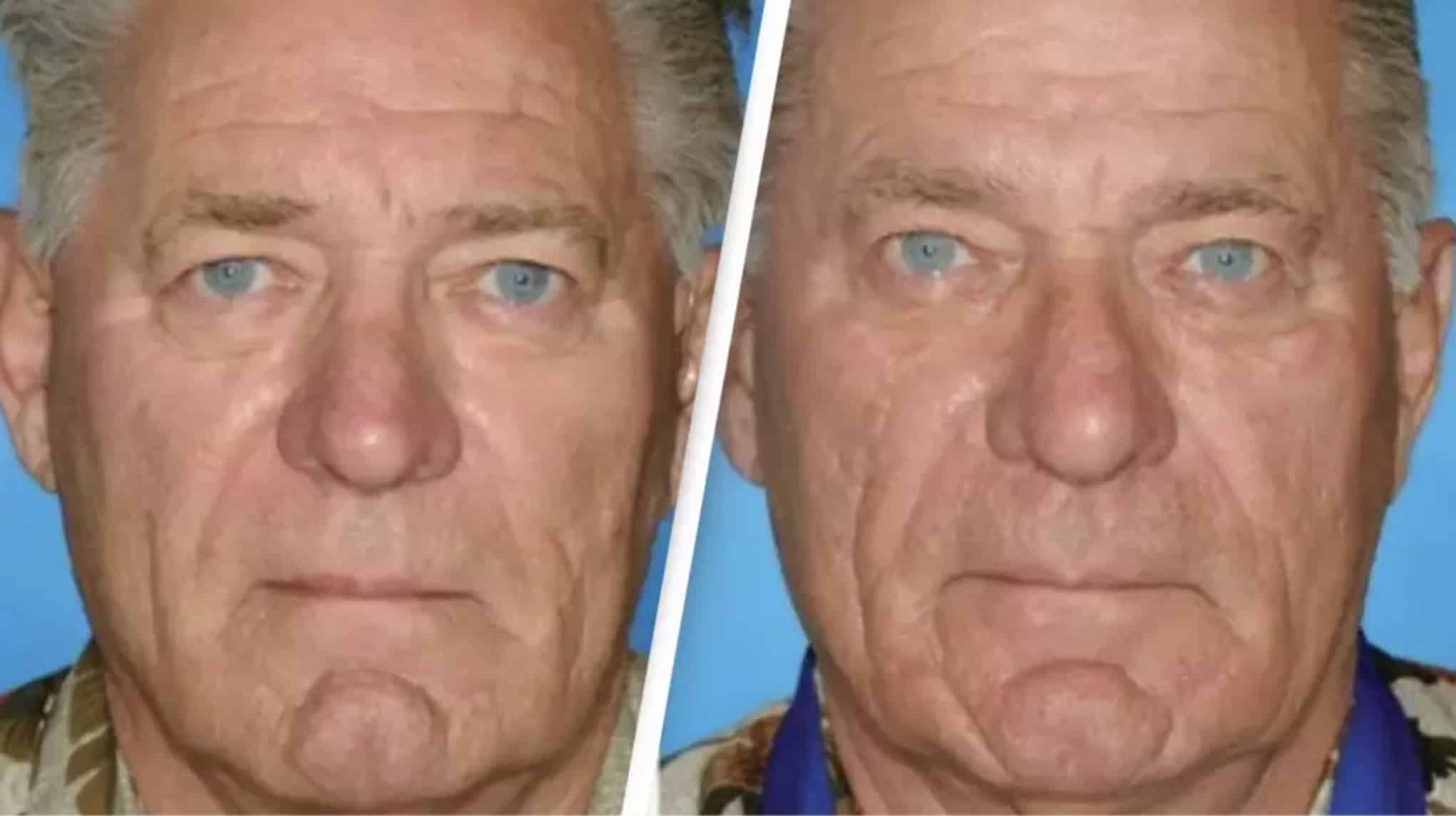 Gêmeos revelam mudança chocante no rosto após um deles fumar e o outro não Gêmeos revelam mudança chocante no rosto após um deles fumar e o outro não