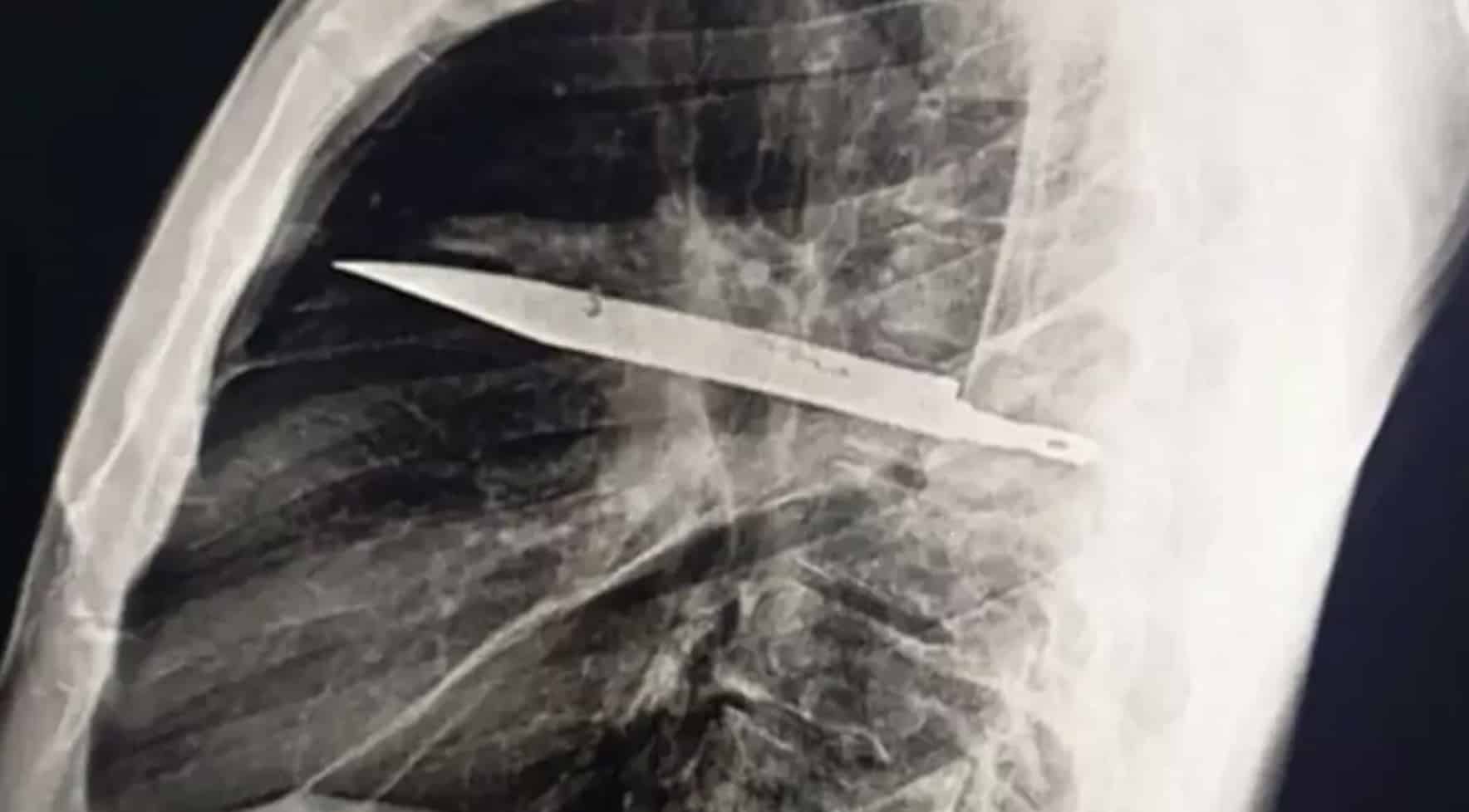 Homem que foi ao hospital após mamilo vazar pus tinha uma faca presa no peito há oito anos