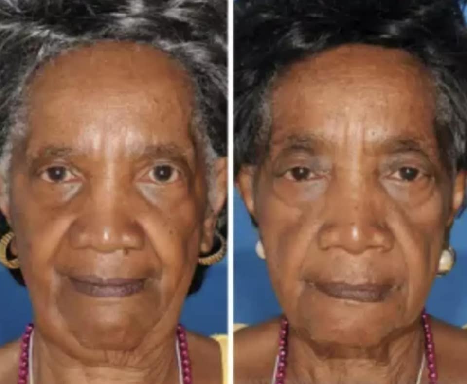 Gêmeos revelam mudança chocante no rosto após um deles fumar e o outro não Médicos dizem que muitas vezes é óbvio quando alguém fuma (Sociedade Americana de Cirurgiões Plásticos)