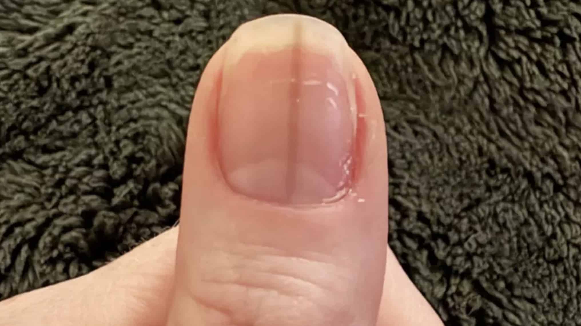 Mulher é aconselhada a procurar um médico imediatamente após postar foto preocupante de sua unha