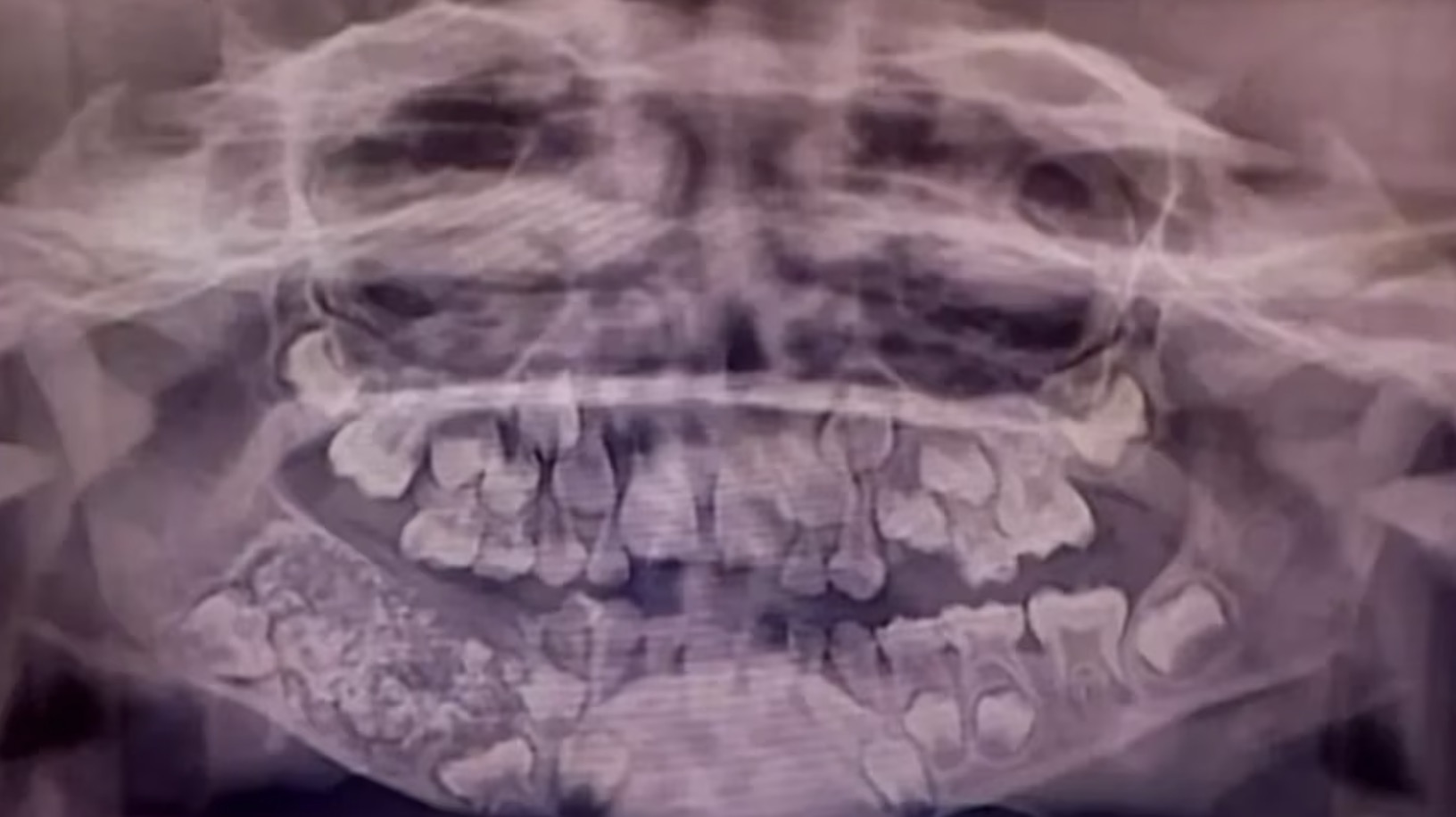 O incrível caso do menino de quem foram extraídos 526 dentes em uma única cirurgia O incrível caso do menino de quem foram extraídos 526 dentes em uma única cirurgia