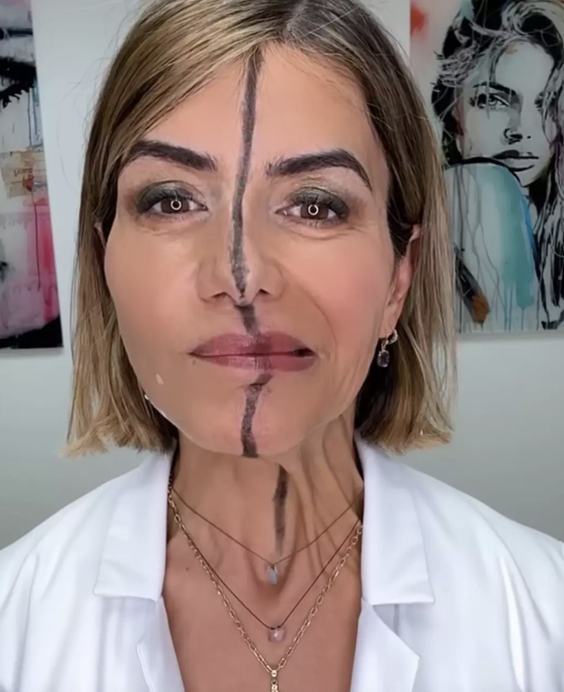 O lado sem aplicação estava muito mais móvel do que o que havia recebido Botox duas semanas antes (Instagram/@drbitafarrell)