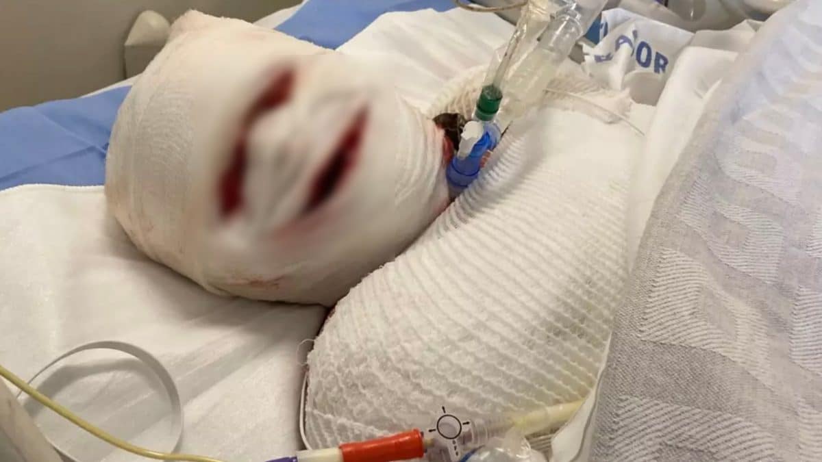 Rosto de mãe "sai" após reação horrível ao ibuprofeno que a deixou em coma