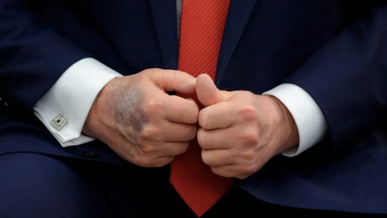 Trump aparece com mão roxa após diagnóstico de insuficiência venosa. O que isso significa?