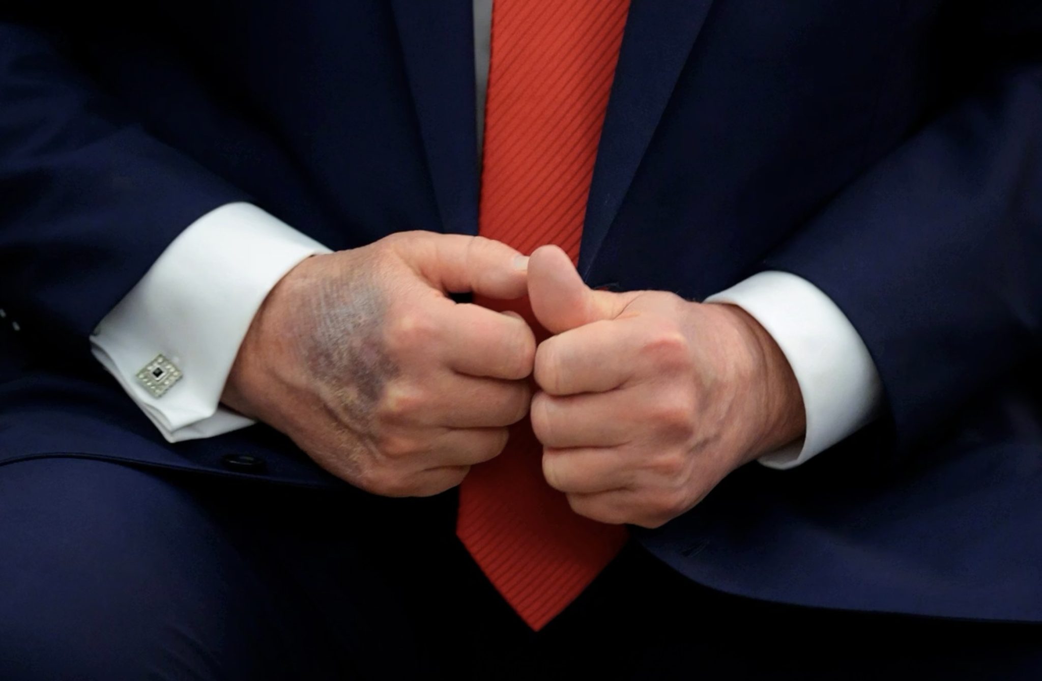 Trump aparece com mão roxa após diagnóstico de insuficiência venosa. O que isso significa?