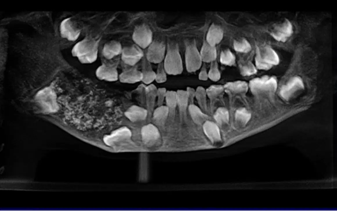 O incrível caso do menino de quem foram extraídos 526 dentes em uma única cirurgia Um raio-X da boca do menino mostra o saco. Saveetha Dental College and Hospital