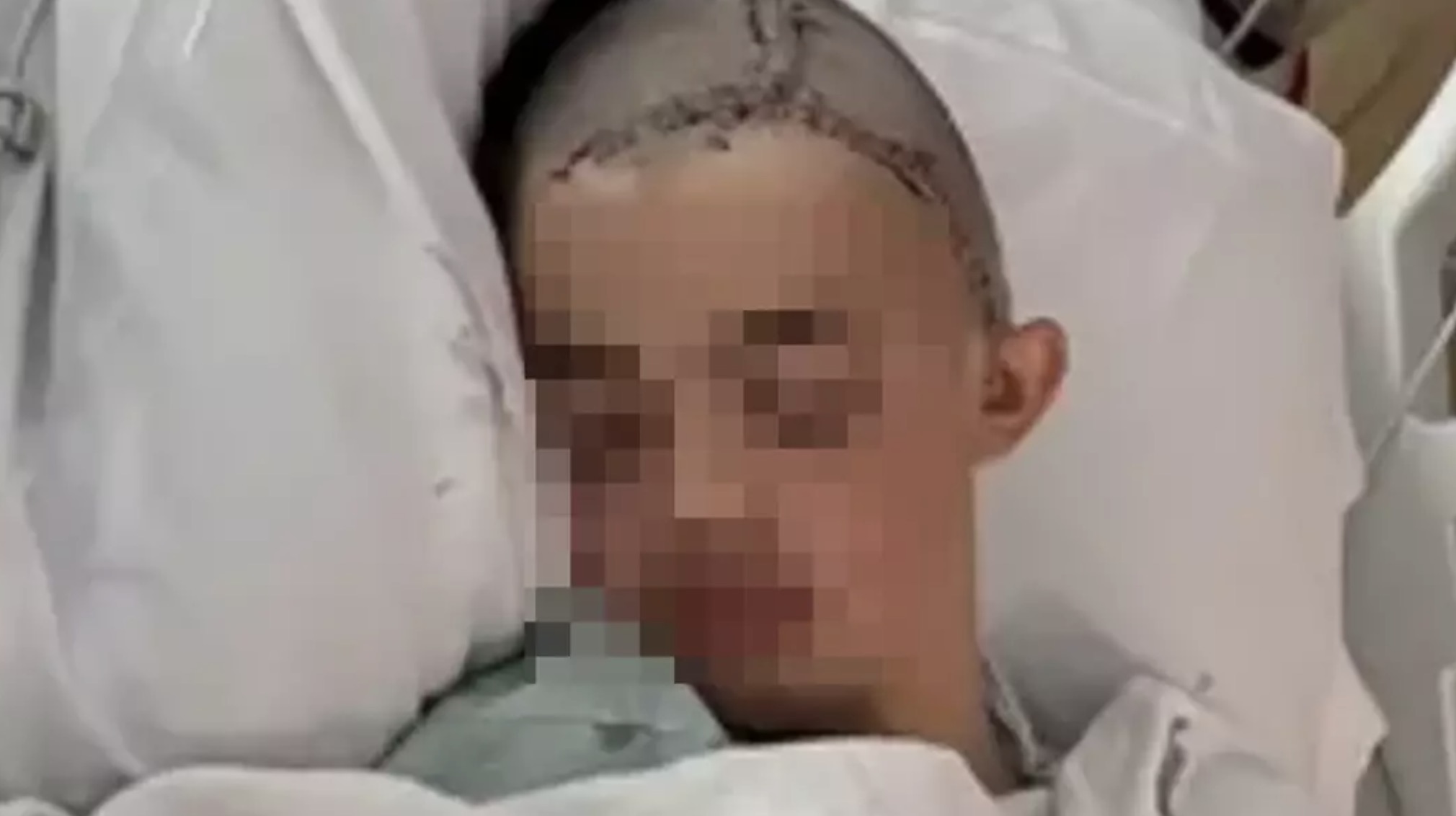 Adolescente atacado por colega após fazer uma piada tem a cabeça reconstruída enquanto a família divulga uma atualização chocante
