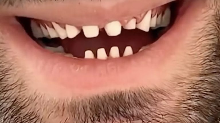 Dentista expõe o lado obscuro de quem faz o procedimento conhecido como "dentes turcos"