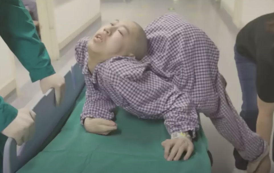 Jiang Yanchen, conhecido como o “menino dobrado”, passou por quatro cirurgias para corrigir a deformidade de 180 graus em sua coluna (YouTube/South China Morning Post)