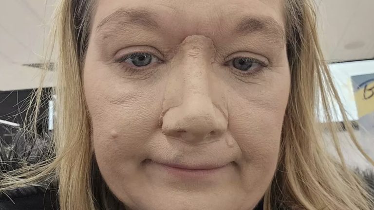 Mulher fica sem nariz após pensar que sangramentos nasais eram causados por "rinite alérgica"