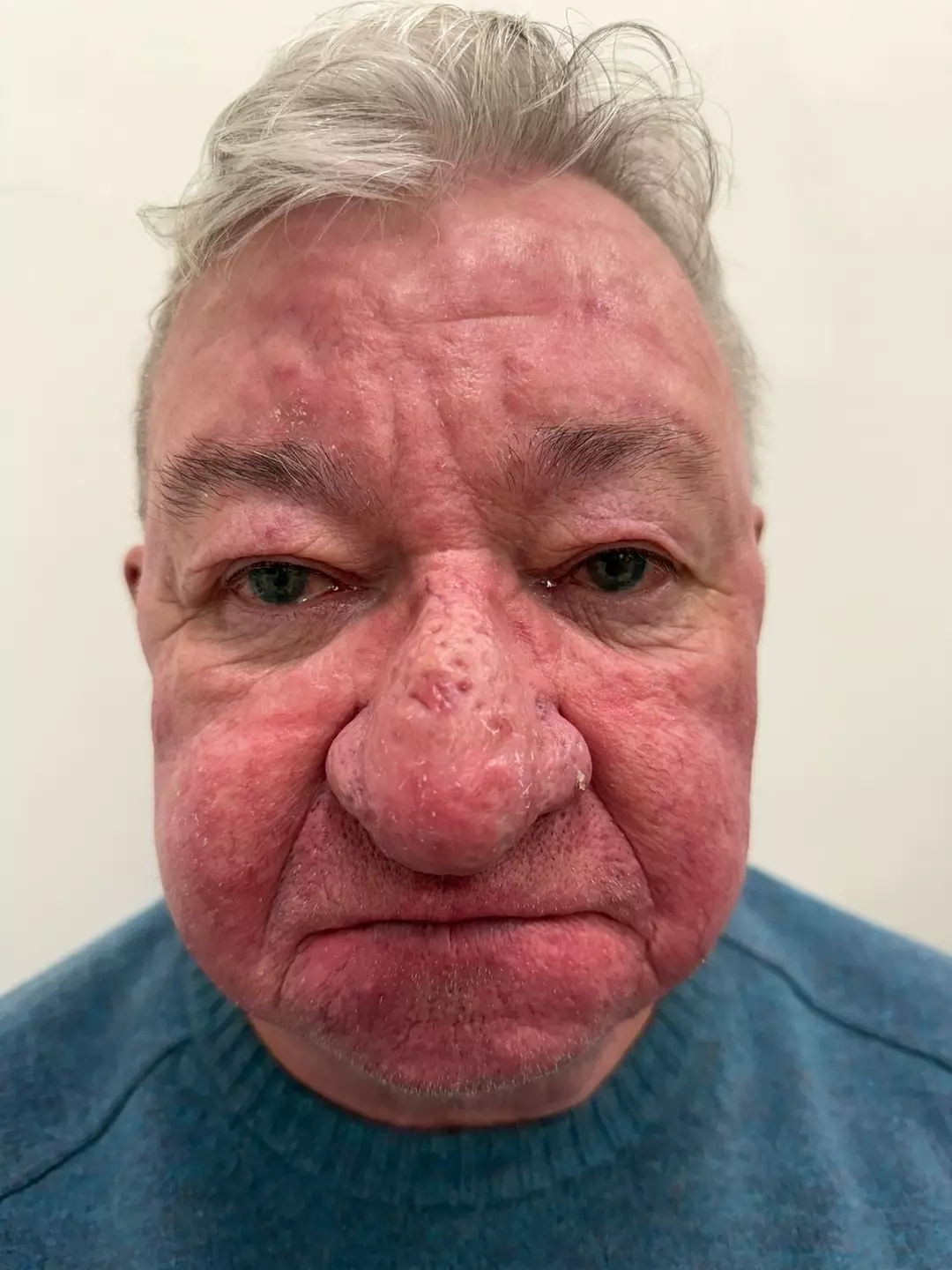 Homem fica incapaz de beijar a esposa após um dos piores casos de crescimento nasal já vistos por médicos