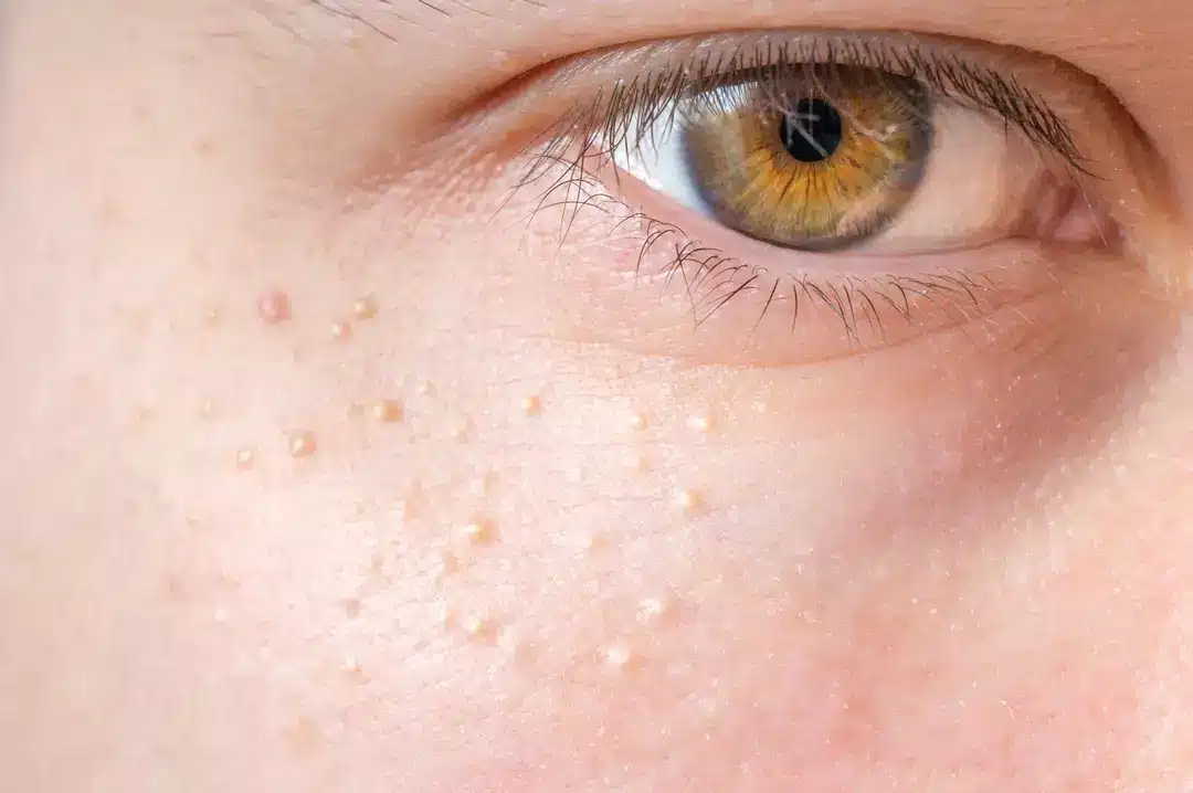 O significado por trás de pequenas bolinhas brancas que podem aparecer em todo o corpo, inclusive nas partes íntimas