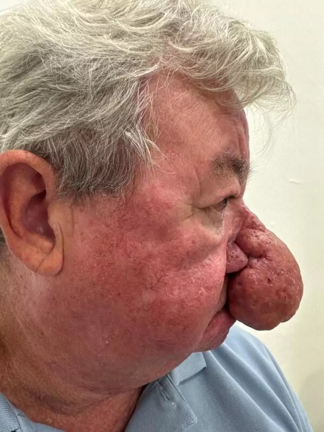 Homem fica incapaz de beijar a esposa após um dos piores casos de crescimento nasal já vistos por médicos