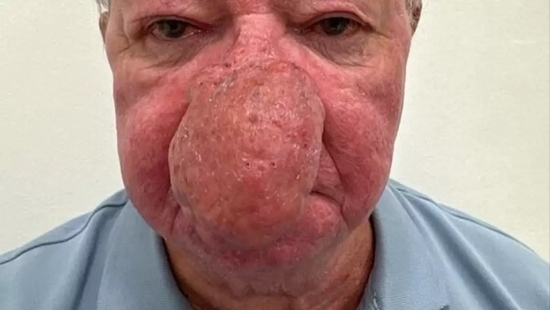 Homem fica incapaz de beijar a esposa após um dos piores casos de crescimento nasal já vistos por médicos