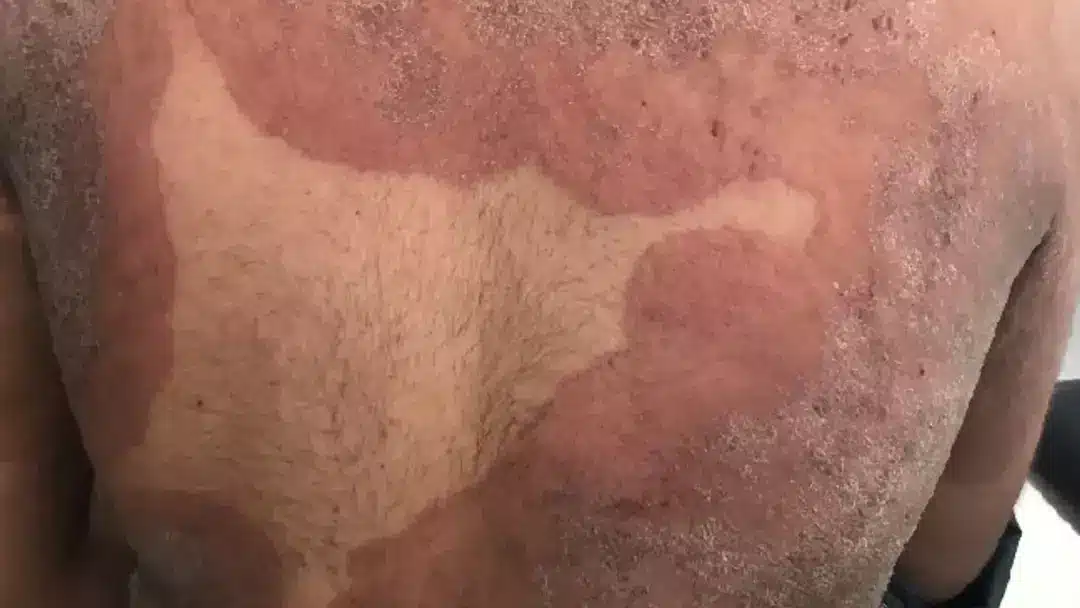Alerta emitido após aparição de “superfungo” que ataca a virilha e nádegas, e é resistente a medicamentos