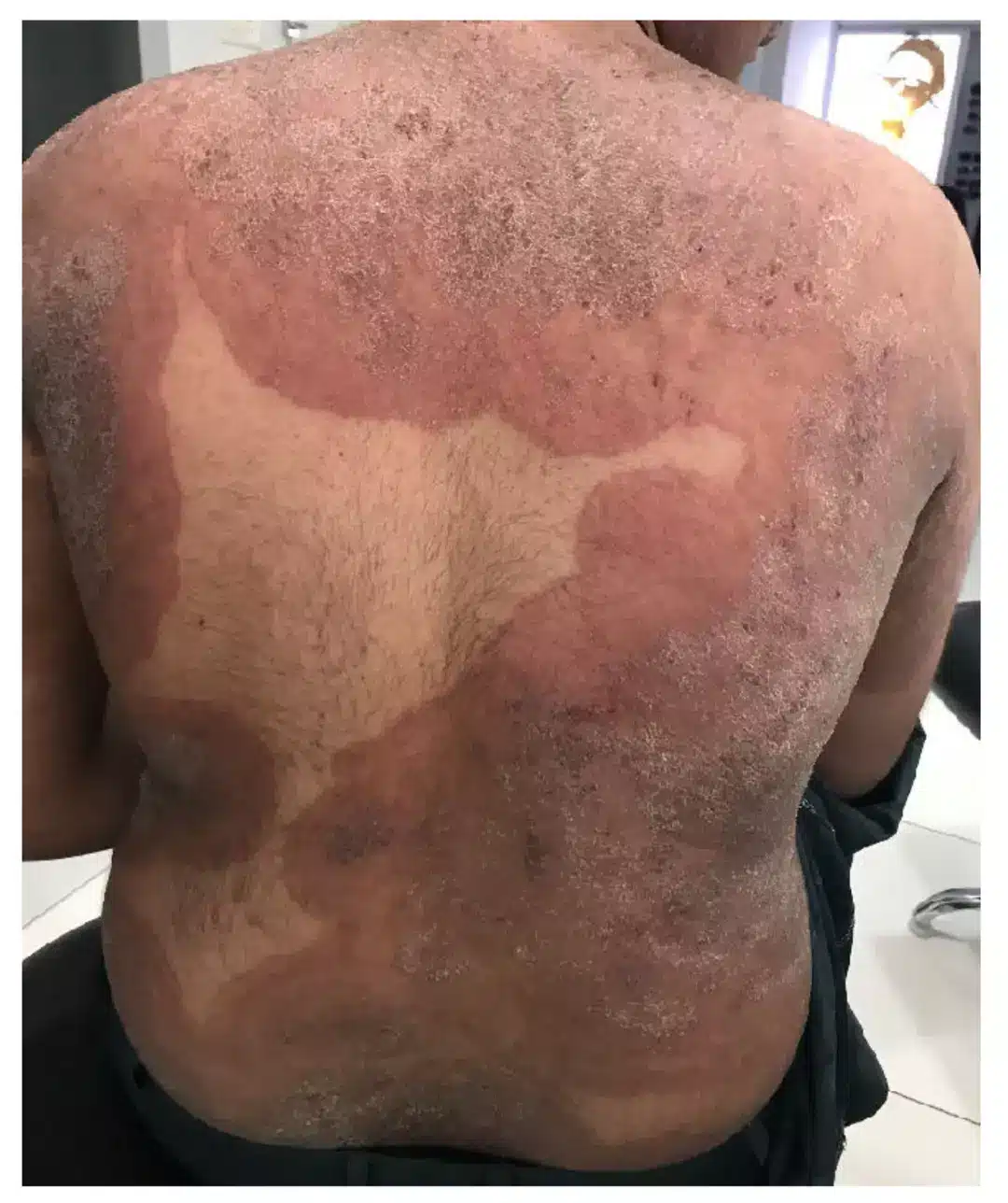 Depois da infecção, ele pode se espalhar para outras partes do corpo (MDPI)