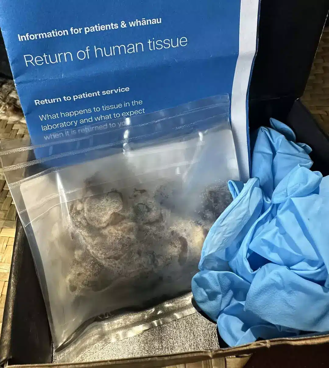 Imagens chocantes mostram o impacto do vape nos pulmões enquanto um adolescente tem órgão retirado do corpo A família pretende enterrá-lo (Kennedy News and Media)