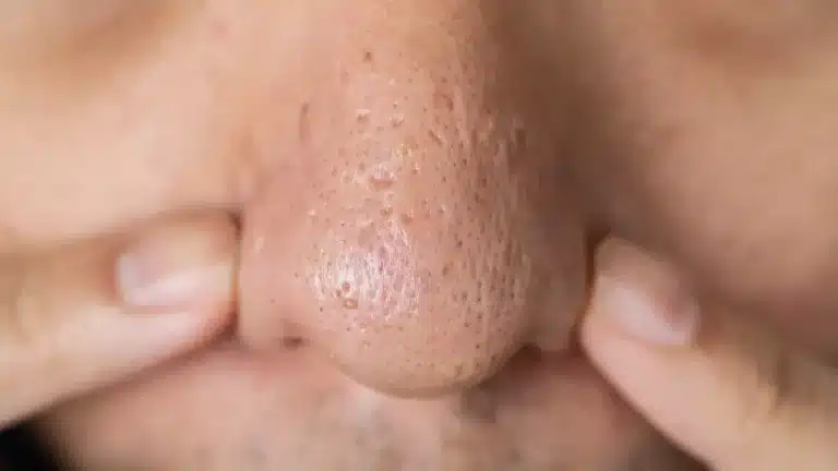 Dermatologista alerta para não espremer os pontinhos pretos do nariz porque eles não são o que você pensa