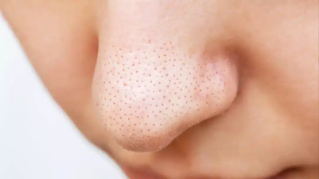 Qual é a diferença entre cravos e os pontinhos pretos do nariz, enquanto dermatologista alerta para não espremer